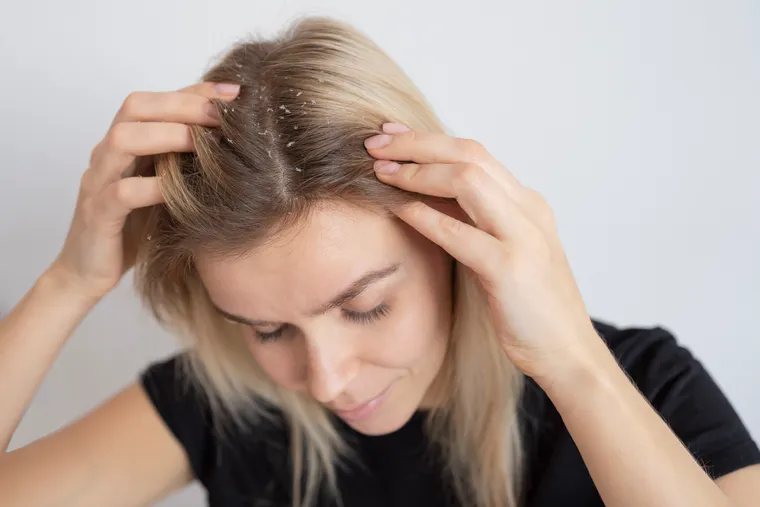 Comprehensive Guide to Treatment Options for Scalp Psoriasis