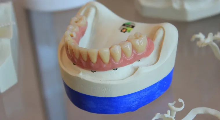 Understanding Same Day Dentures: A Quick Guide