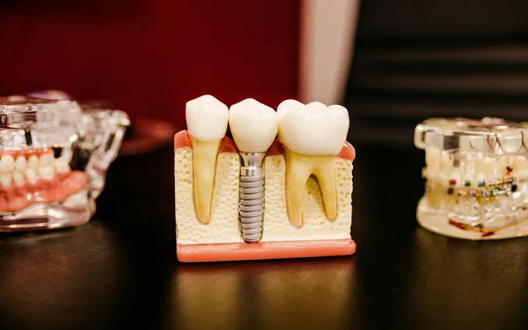 Affordable Tooth Replacement Options: What You Need to Know