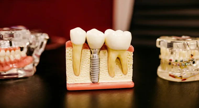 Finding the Best Dental Implants Near You: A Comprehensive Guide