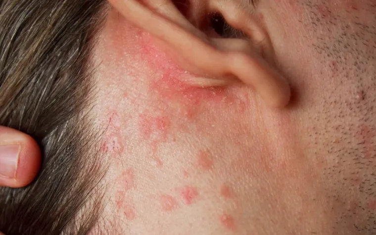 Effective Psoriasis Creams: Top Treatments to Soothe, Heal, and Restore Your Skin