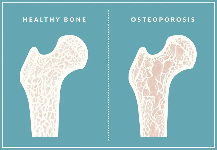 Stronger Bones Ahead: Effective Osteoporosis Treatments to Prevent Fractures and Boost Mobility