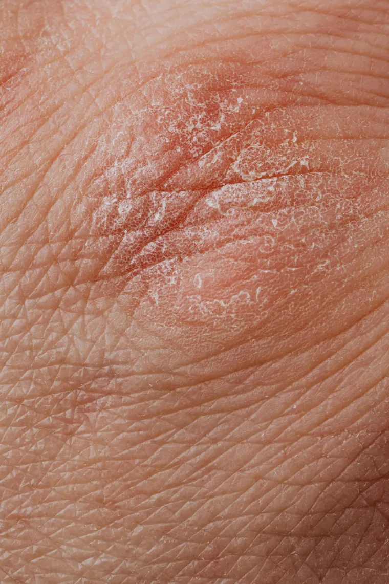 Psoriasis Treatment in 2025: What’s New and What Works Best