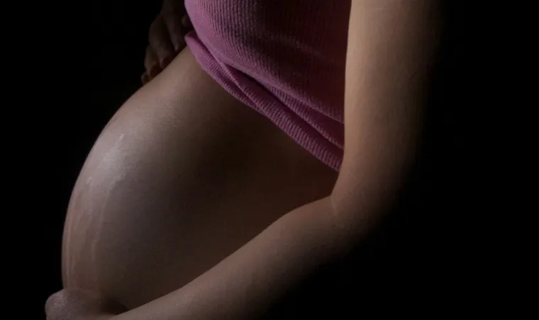 Laser Stretch Mark Removal: Cost, Results, and Best Treatment Options