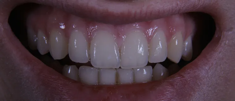 Screwless Dental Implants: What You Should Know